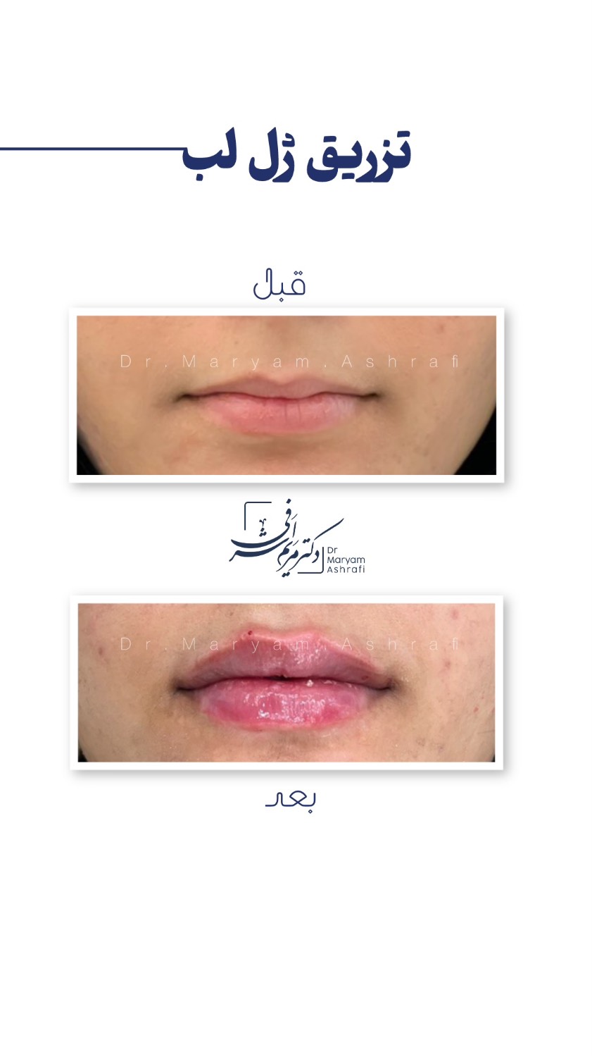 لب مدل روسی