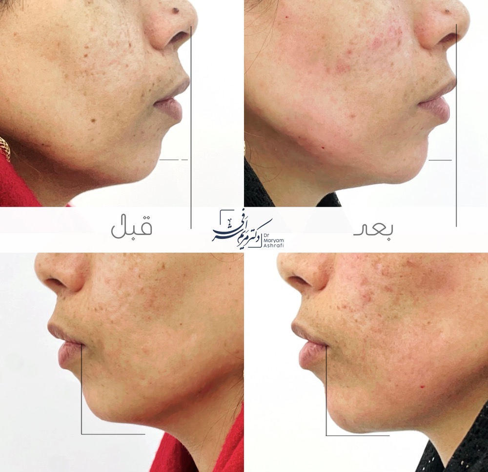 قبل و بعد از تزریق ژل چانه