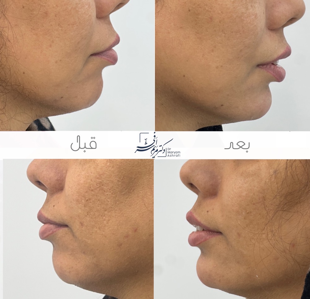 قبل و بعد از تزریق ژل چانه