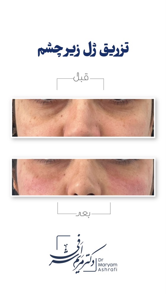 قبل و بعد از تزریق ژل زیر چشم