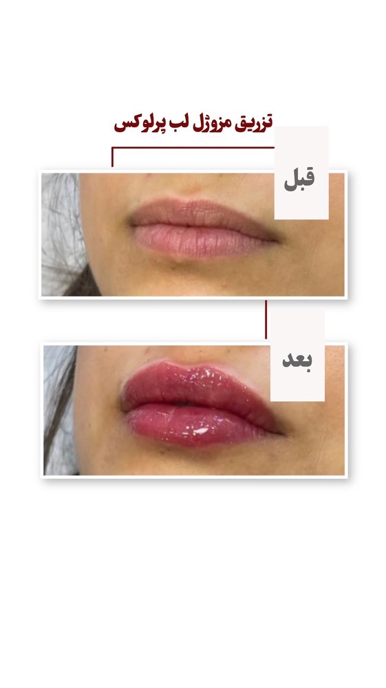قبل و بعد از مزوژل لب