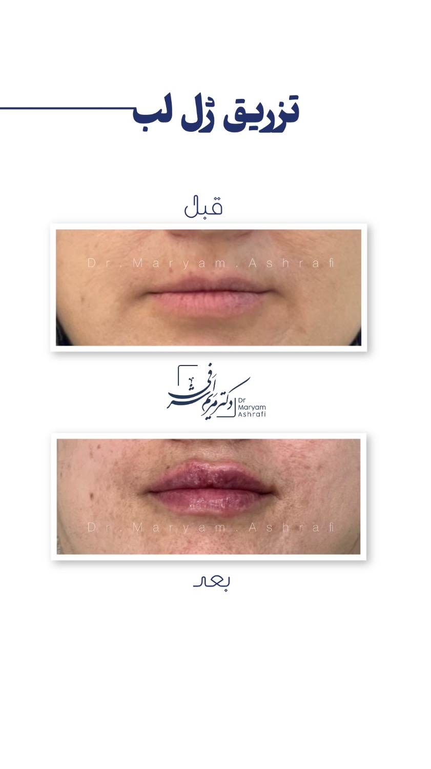 تزریق ژل لب